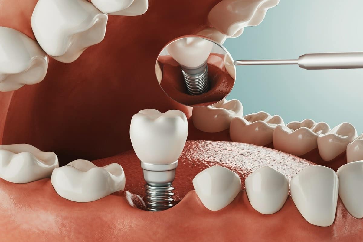 implant zęba