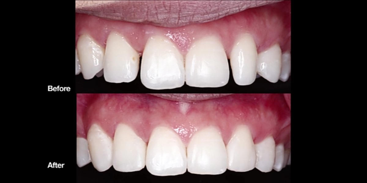 licówki porcelanowe na zęby